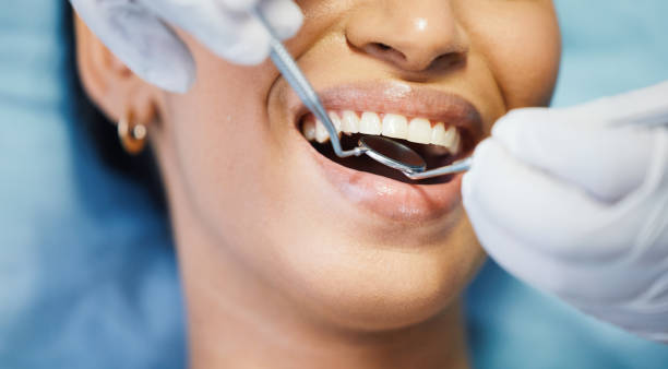 Best Emergency Wisdom Teeth Removal in French Mp, CA